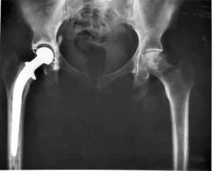 MRI Detects Adverse Events in Metal on Metal Hips, Study Shows